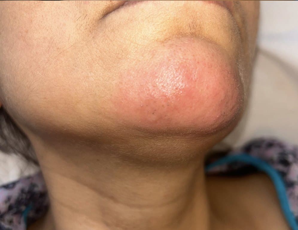 Chin after treatment