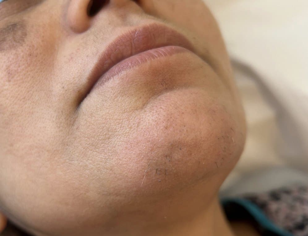 Chin before