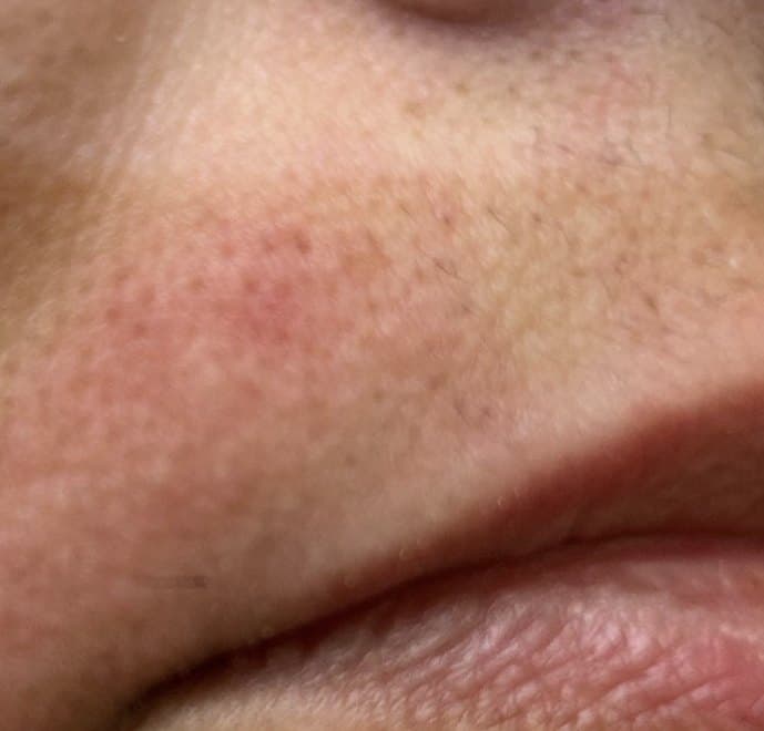 Upper lip after treatment