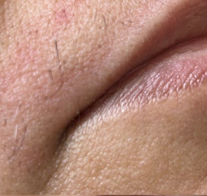 Upper lip before